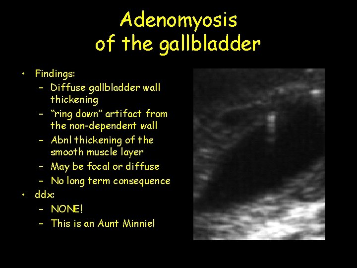 Adenomyosis of the gallbladder • Findings: – Diffuse gallbladder wall thickening – “ring down”