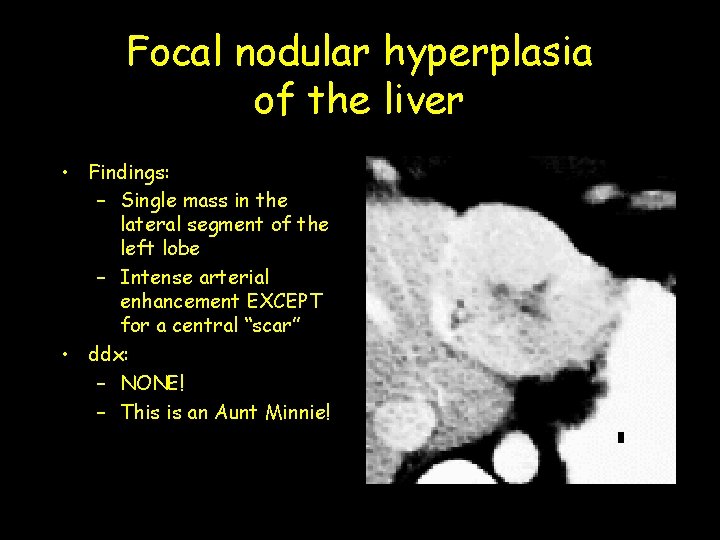 Focal nodular hyperplasia of the liver • Findings: – Single mass in the lateral