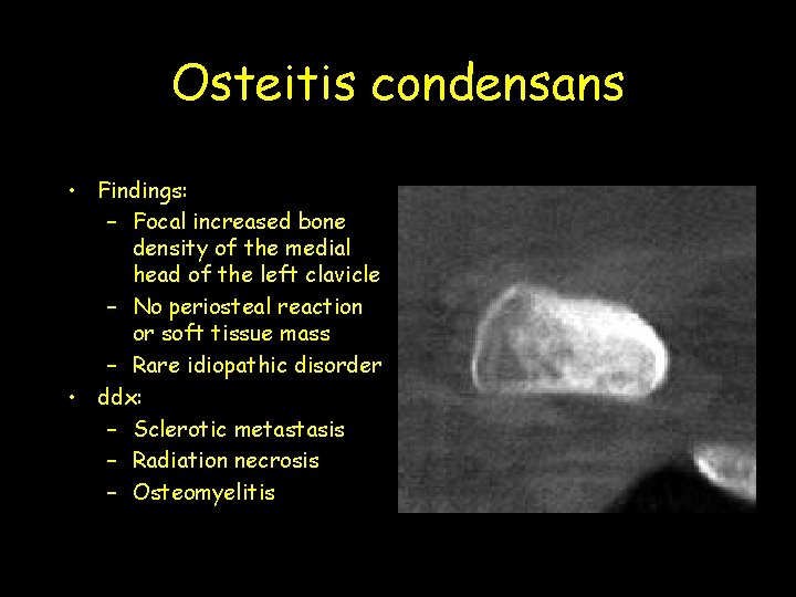 Osteitis condensans • Findings: – Focal increased bone density of the medial head of