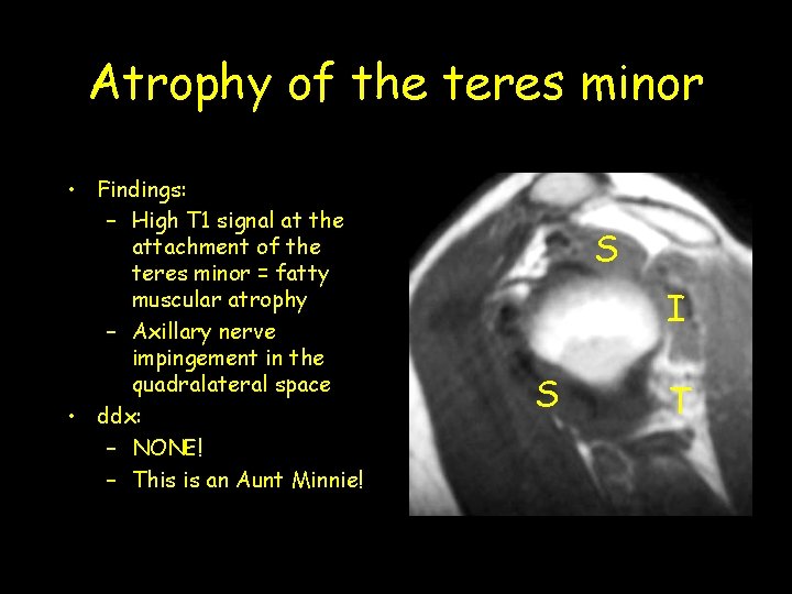 Atrophy of the teres minor • Findings: – High T 1 signal at the