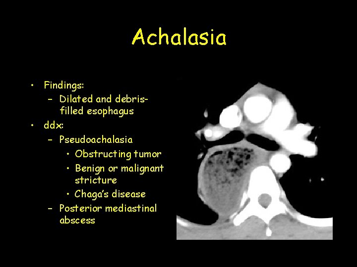 Achalasia • Findings: – Dilated and debrisfilled esophagus • ddx: – Pseudoachalasia • Obstructing