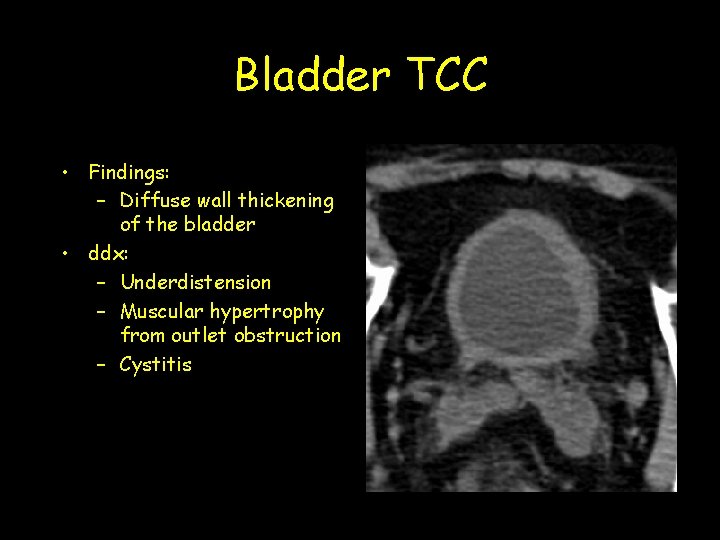 Bladder TCC • Findings: – Diffuse wall thickening of the bladder • ddx: –