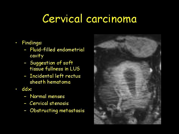 Cervical carcinoma • Findings: – Fluid-filled endometrial cavity – Suggestion of soft tissue fullness