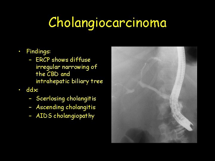 Cholangiocarcinoma • Findings: – ERCP shows diffuse irregular narrowing of the CBD and intrahepatic