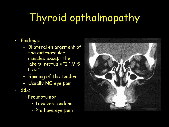Thyroid opthalmopathy • Findings: – Bilateral enlargement of the extraoccular muscles except the lateral