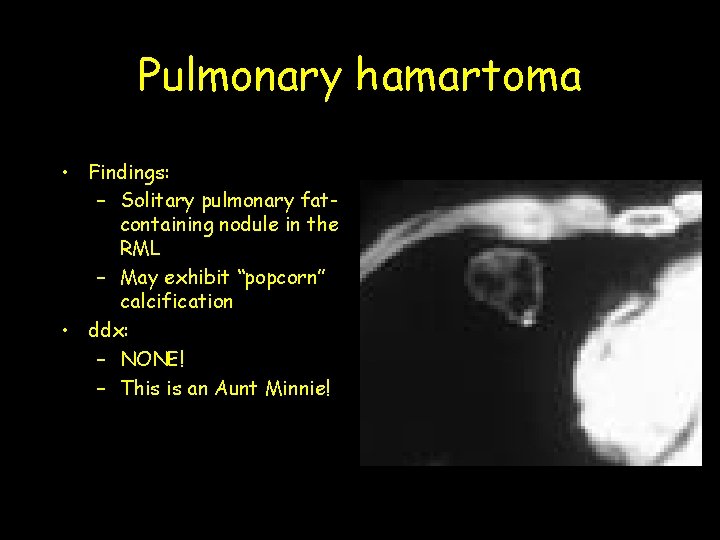 Pulmonary hamartoma • Findings: – Solitary pulmonary fatcontaining nodule in the RML – May