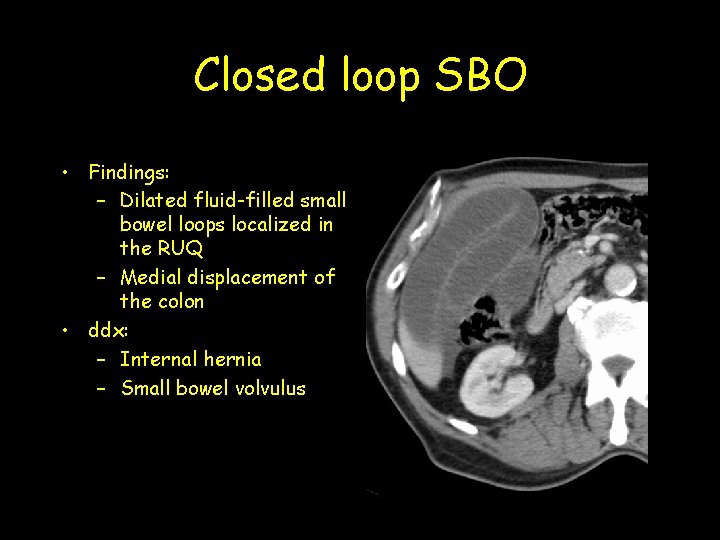 Closed loop SBO • Findings: – Dilated fluid-filled small bowel loops localized in the