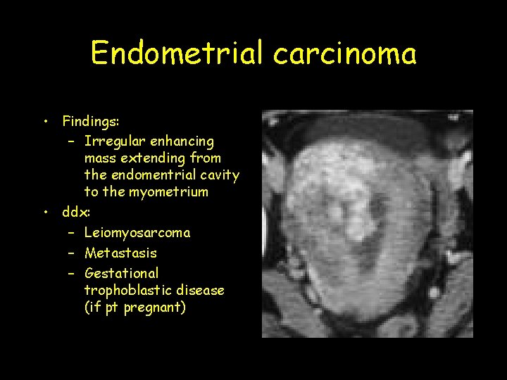 Endometrial carcinoma • Findings: – Irregular enhancing mass extending from the endomentrial cavity to