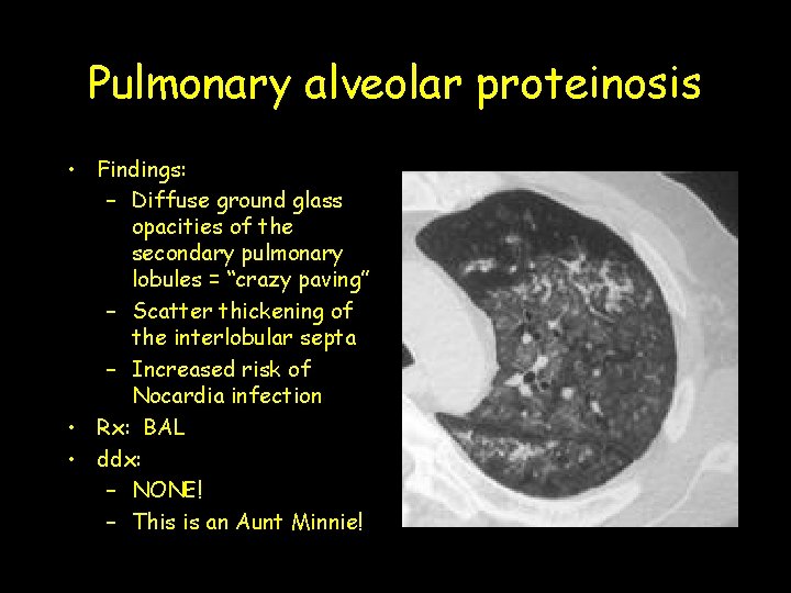 Pulmonary alveolar proteinosis • Findings: – Diffuse ground glass opacities of the secondary pulmonary
