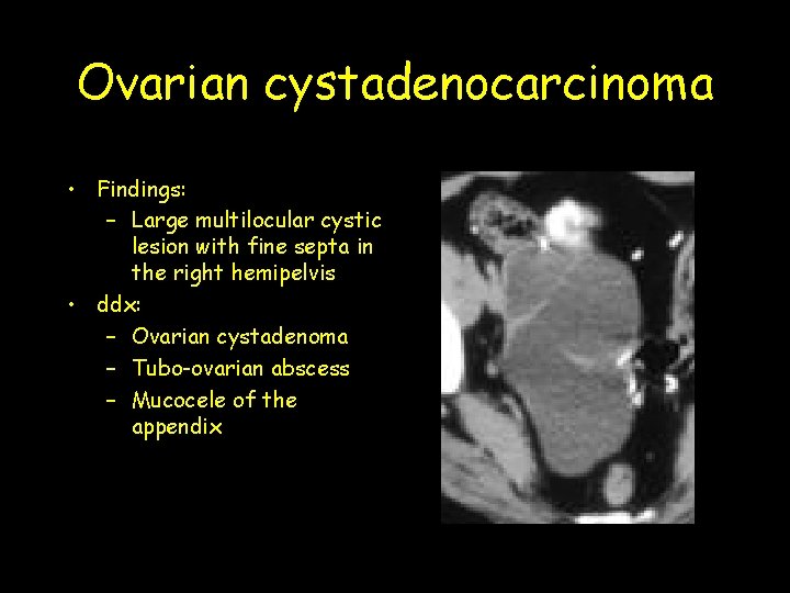Ovarian cystadenocarcinoma • Findings: – Large multilocular cystic lesion with fine septa in the