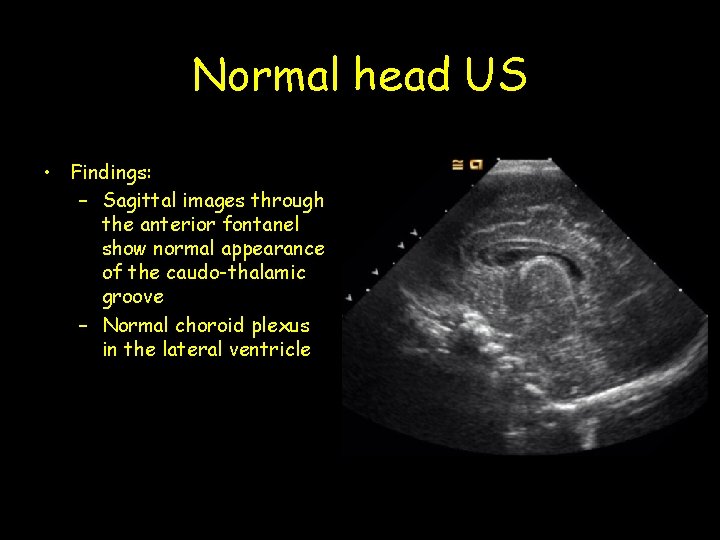 Normal head US • Findings: – Sagittal images through the anterior fontanel show normal