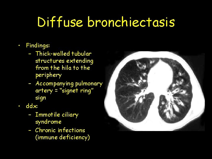 Diffuse bronchiectasis • Findings: – Thick-walled tubular structures extending from the hila to the