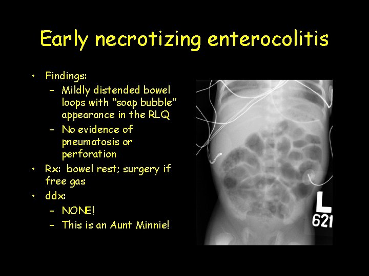 Early necrotizing enterocolitis • Findings: – Mildly distended bowel loops with “soap bubble” appearance