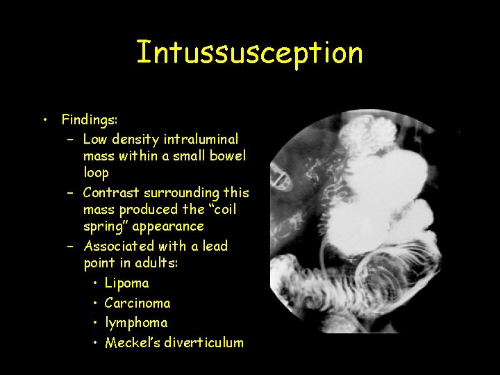 Intussusception • Findings: – Low density intraluminal mass within a small bowel loop –