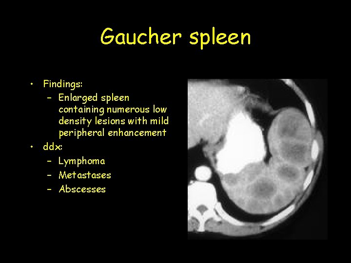 Gaucher spleen • Findings: – Enlarged spleen containing numerous low density lesions with mild