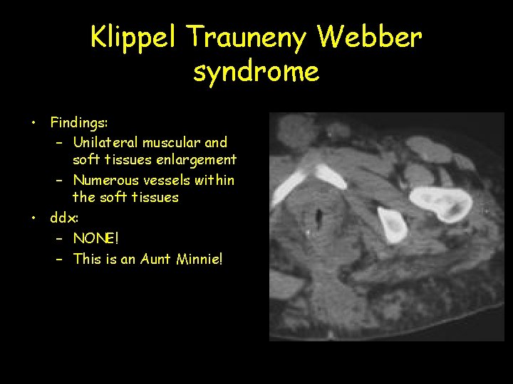 Klippel Trauneny Webber syndrome • Findings: – Unilateral muscular and soft tissues enlargement –