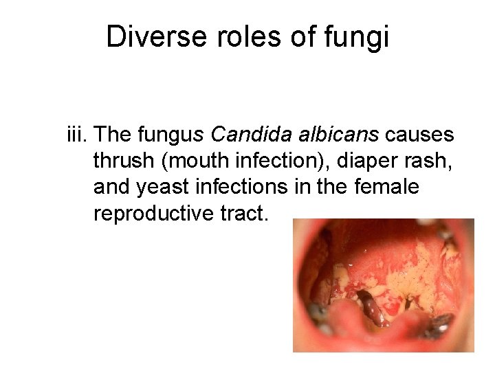 Diverse roles of fungi iii. The fungus Candida albicans causes thrush (mouth infection), diaper