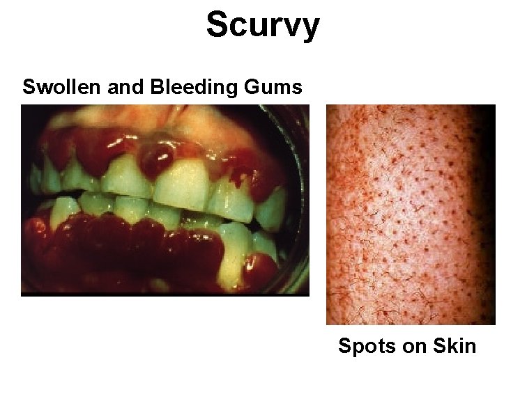 Scurvy Swollen and Bleeding Gums Spots on Skin 