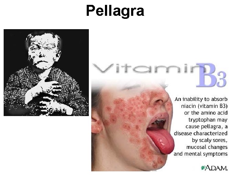 Pellagra 