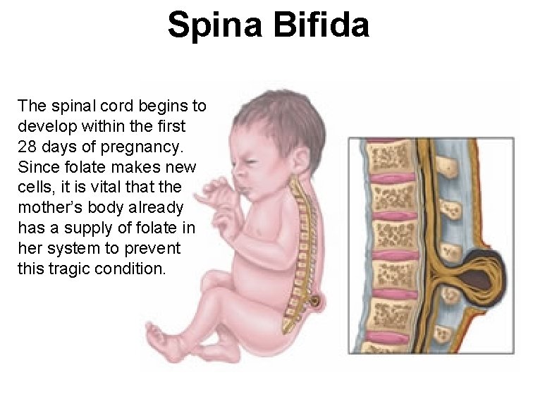 Spina Bifida The spinal cord begins to develop within the first 28 days of