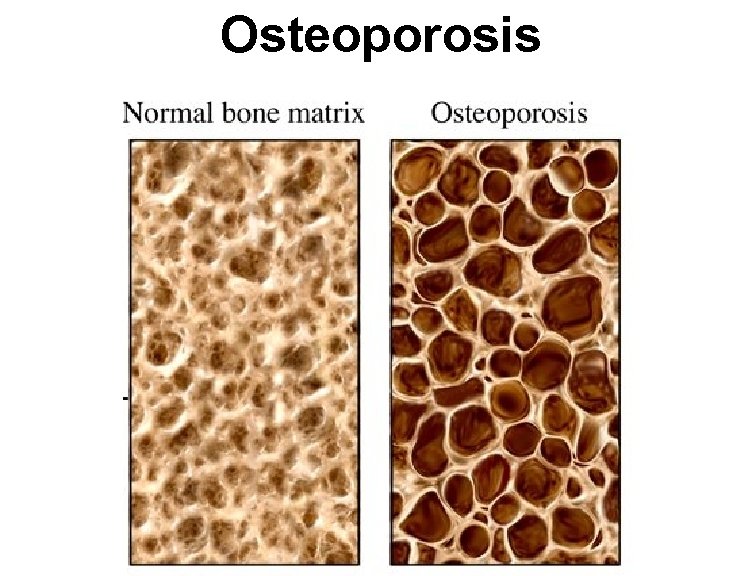 Osteoporosis 