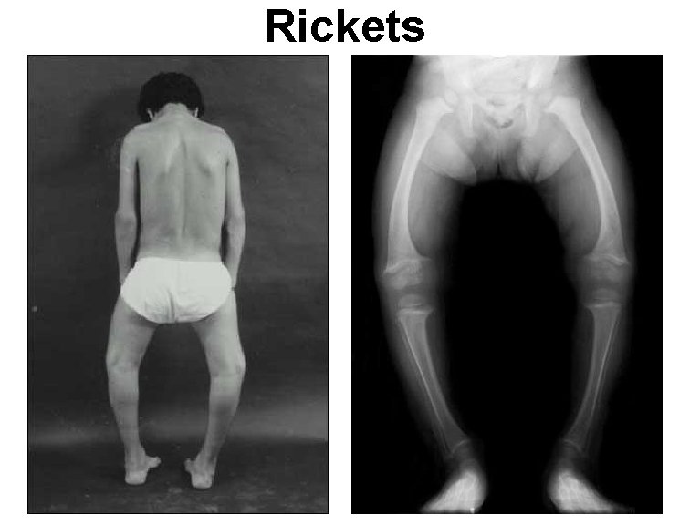 Rickets 