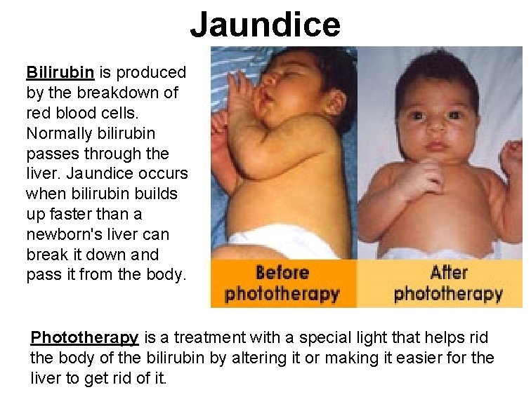 Jaundice Bilirubin is produced by the breakdown of red blood cells. Normally bilirubin passes
