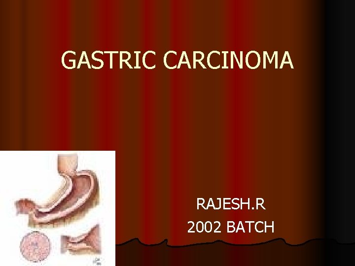 GASTRIC CARCINOMA RAJESH. R 2002 BATCH 