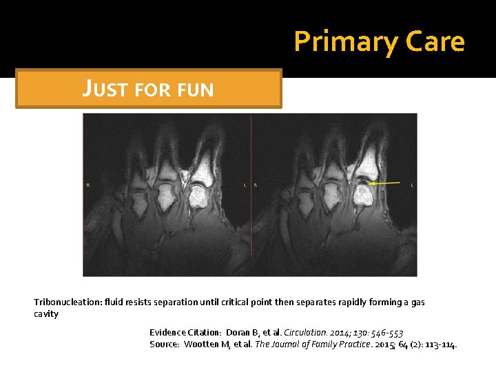 Primary Care JUST FOR FUN Tribonucleation: fluid resists separation until critical point then separates