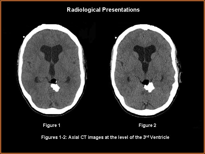 Radiological Presentations Figure 1 Figure 2 Figures 1 -2: Axial CT images at the