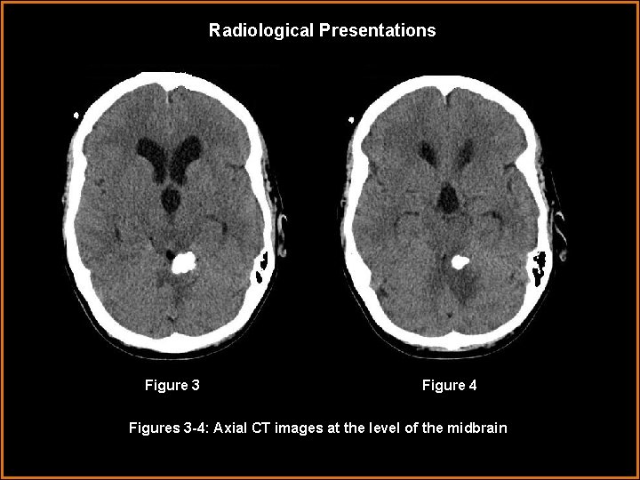 Radiological Presentations Figure 3 Figure 4 Figures 3 -4: Axial CT images at the