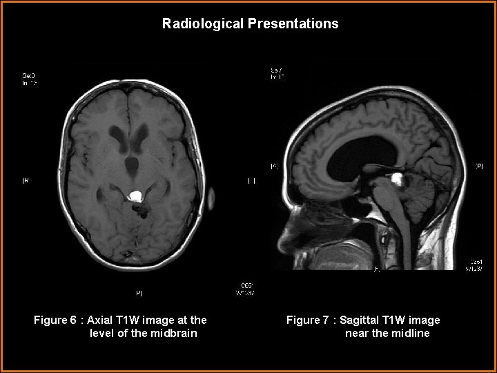 Radiological Presentations Figure 6 : Axial T 1 W image at the level of