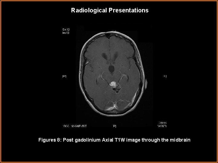 Radiological Presentations Figures 8: Post gadolinium Axial T 1 W image through the midbrain