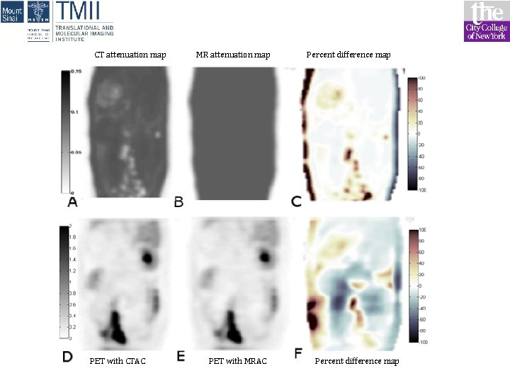 CT attenuation map PET with CTAC MR attenuation map PET with MRAC Percent difference