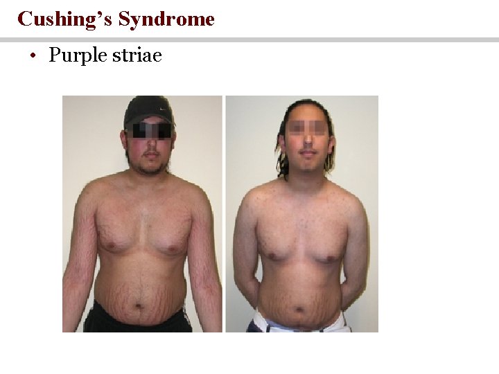 Cushing’s Syndrome • Purple striae 