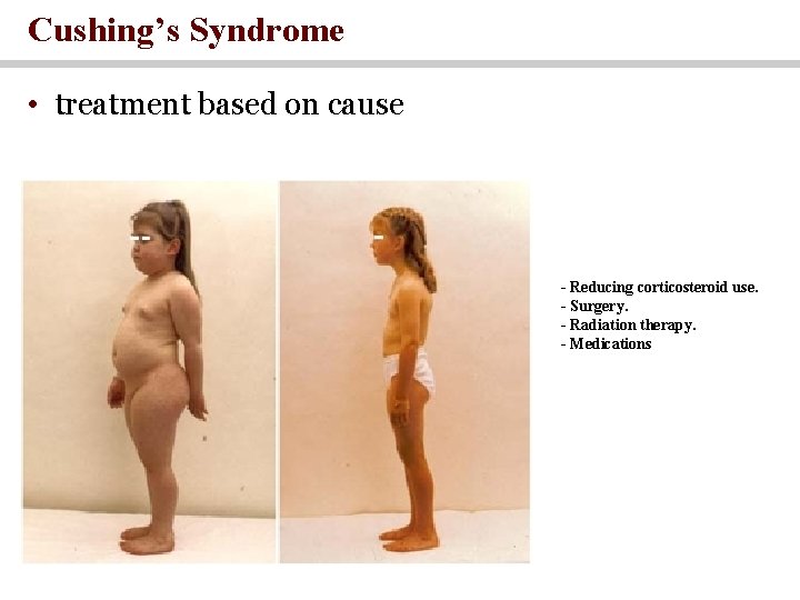Cushing’s Syndrome • treatment based on cause - Reducing corticosteroid use. - Surgery. -