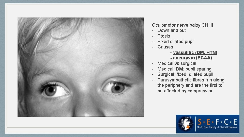 Oculomotor nerve palsy CN III - Down and out - Ptosis - Fixed dilated