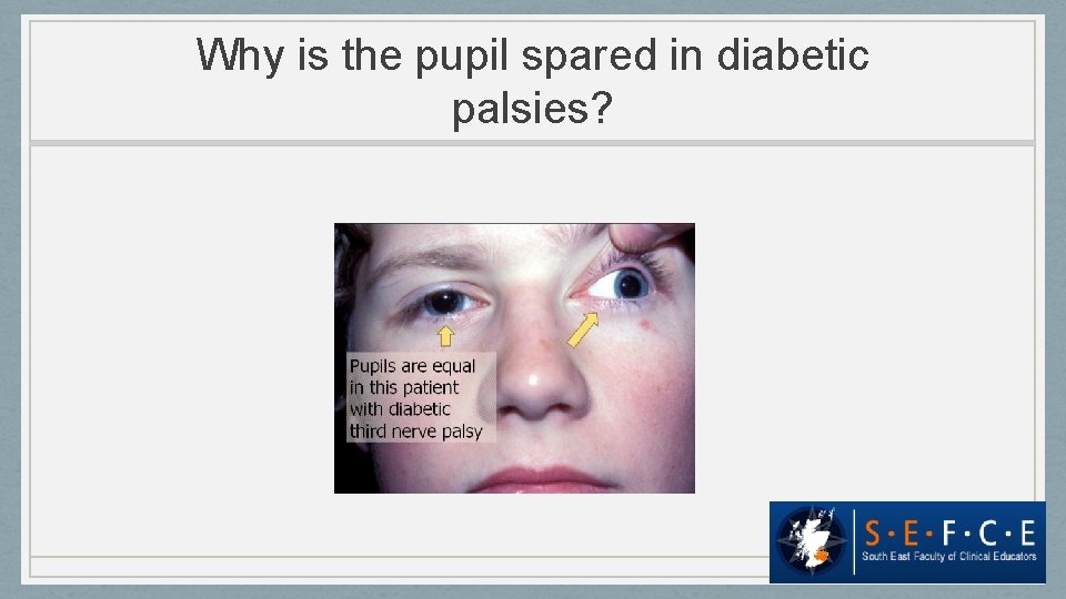 Why is the pupil spared in diabetic palsies? 