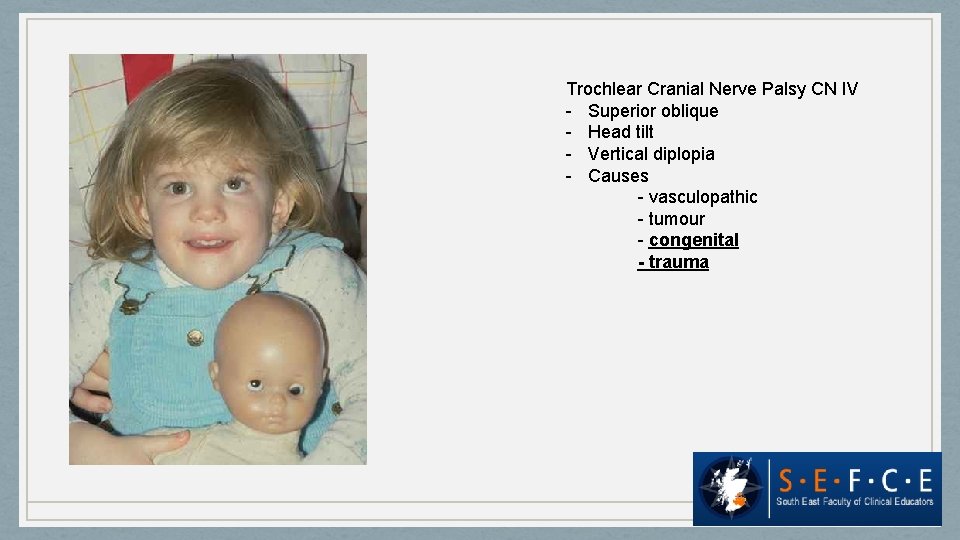 Trochlear Cranial Nerve Palsy CN IV - Superior oblique - Head tilt - Vertical