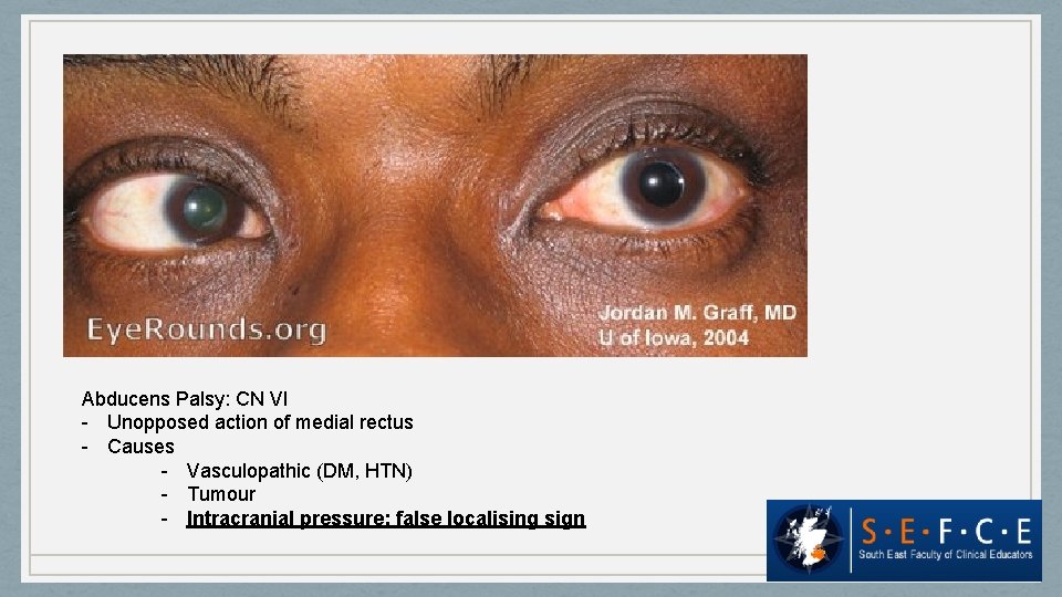 Abducens Palsy: CN VI - Unopposed action of medial rectus - Causes - Vasculopathic