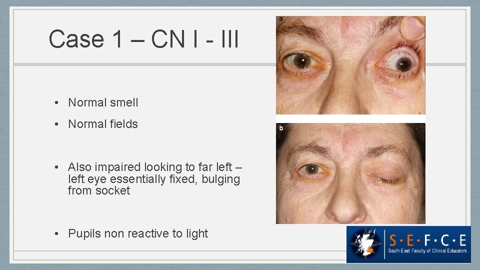 Case 1 – CN I - III • Normal smell • Normal fields •