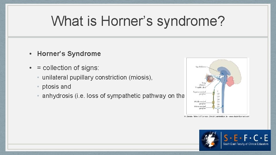 What is Horner’s syndrome? • Horner’s Syndrome • = collection of signs: • unilateral