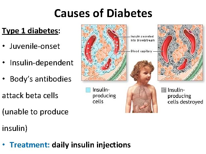 Causes of Diabetes Type 1 diabetes: • Juvenile-onset • Insulin-dependent • Body’s antibodies attack Causes of Diabetes Type 1 diabetes: • Juvenile-onset • Insulin-dependent • Body’s antibodies attack