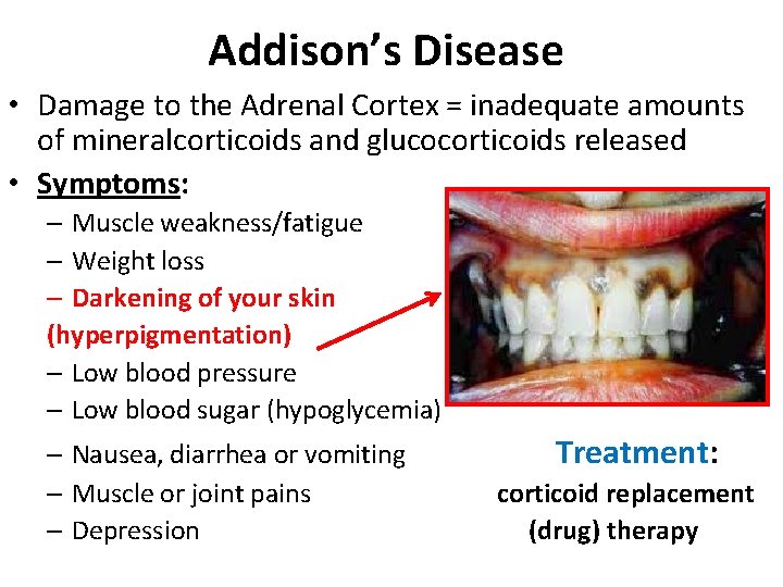Addison’s Disease • Damage to the Adrenal Cortex = inadequate amounts of mineralcorticoids and Addison’s Disease • Damage to the Adrenal Cortex = inadequate amounts of mineralcorticoids and