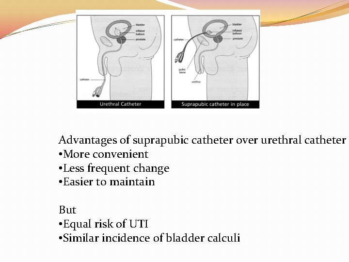 Advantages of suprapubic catheter over urethral catheter • More convenient • Less frequent change