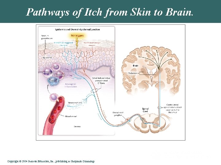 Pathways of Itch from Skin to Brain. Yosipovitch G, Bernhard JD. N Engl J