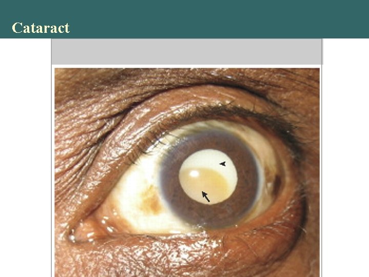 Cataract Copyright © 2004 Pearson Education, Inc. , publishing as Benjamin Cummings 