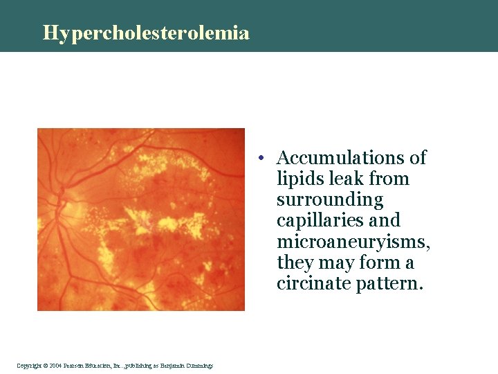 Hypercholesterolemia • Accumulations of lipids leak from surrounding capillaries and microaneuryisms, they may form