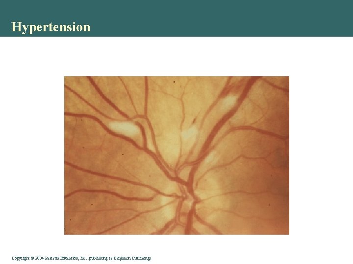 Hypertension Copyright © 2004 Pearson Education, Inc. , publishing as Benjamin Cummings 