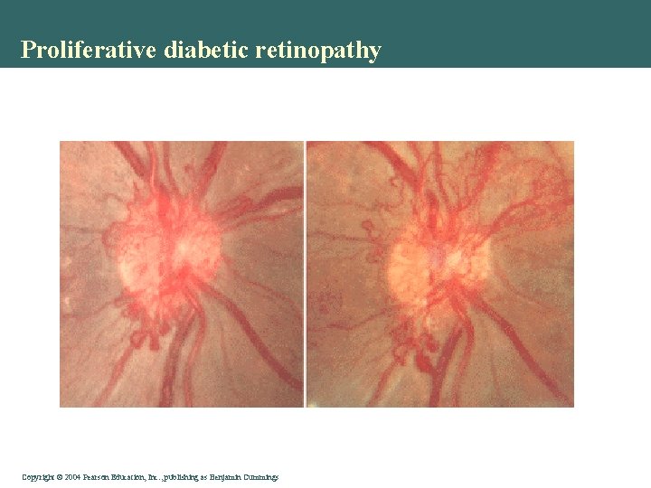 Proliferative diabetic retinopathy Copyright © 2004 Pearson Education, Inc. , publishing as Benjamin Cummings